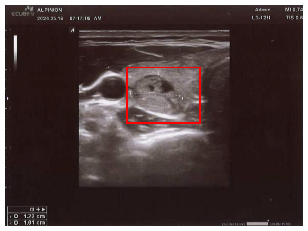 Pajzsmirigy göb ultrahang felvételen
