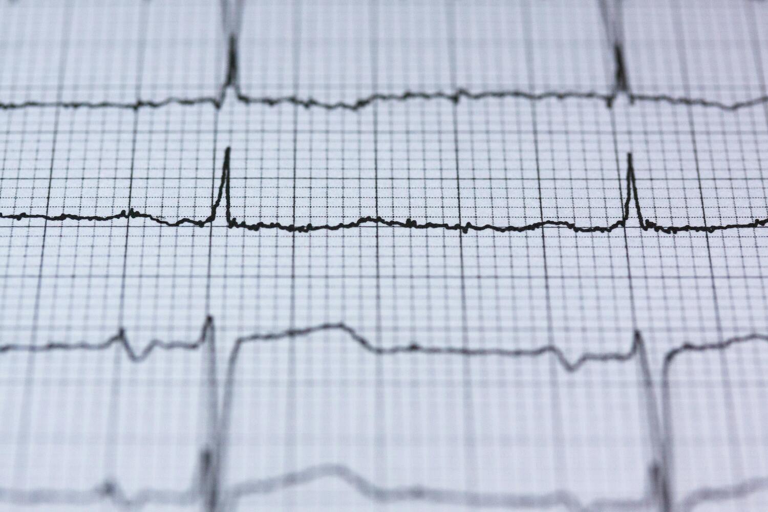 szívritmuszavar vizsgálat - EKG